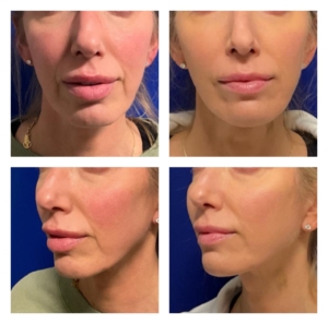 Liquid Facelift