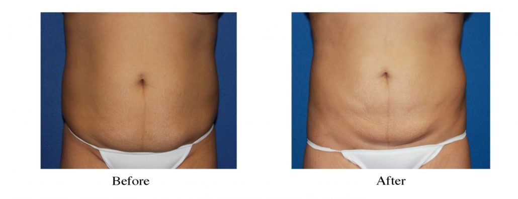 Liposuction - Abdomen / Flanks Before and After Photo Gallery, Coeur  d'Alene, ID